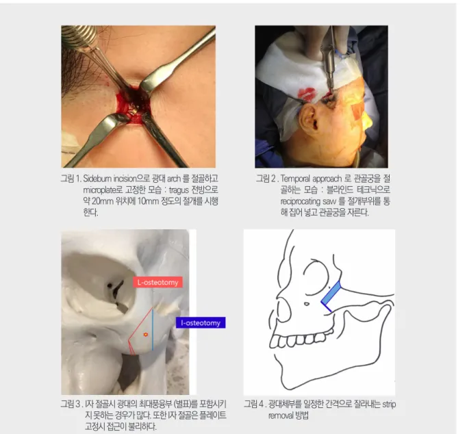 그림 1.   Sideburn incision으로 광대 arch 를 절골하고  microplate로 고정한 모습 : tragus 전방으로  약 20mm 위치에 10mm 정도의 절개를 시행 한다