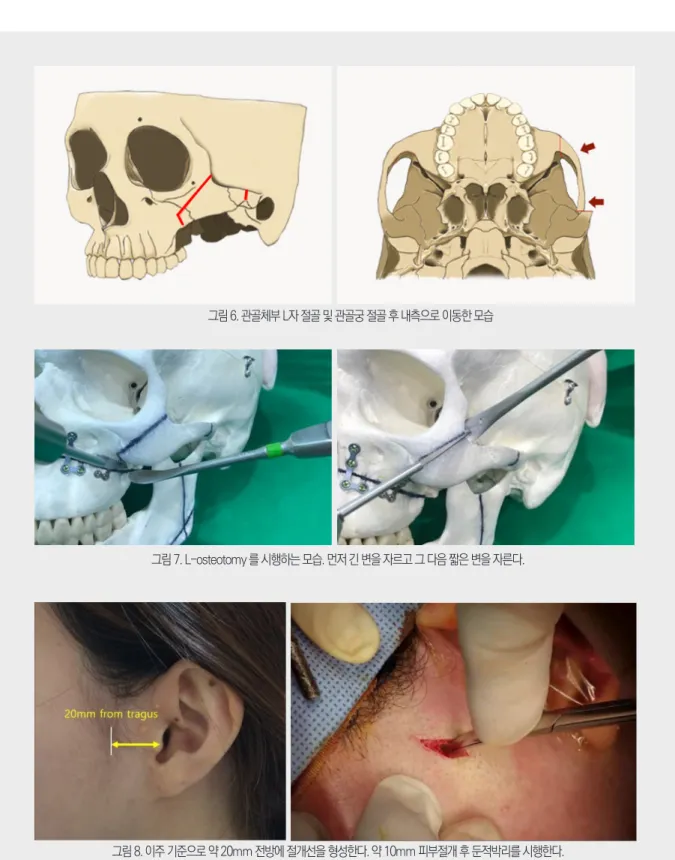 그림 7. L-osteotomy 를 시행하는 모습. 먼저 긴 변을 자르고 그 다음 짧은 변을 자른다.