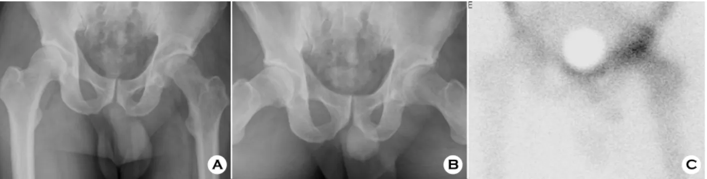 Fig. 3. Radiographs 1 year after open reduction (A, B) show concentrically reduced head with adequate joint space and bone scan (C) shows no evidence of  avascular necrosis