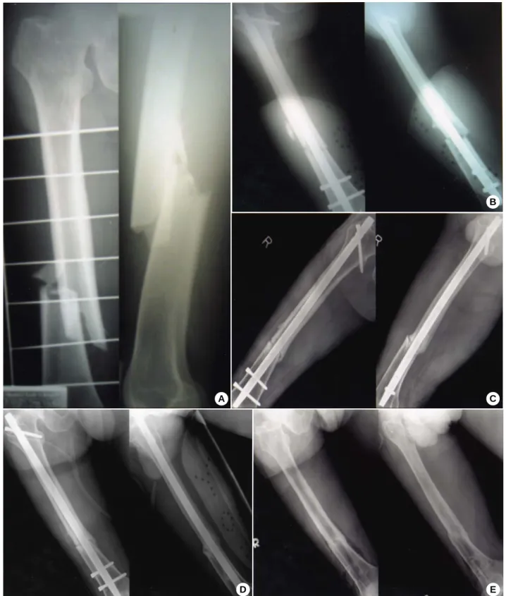 Fig. 1. A 55-year old male with interlocking IM nailing. 