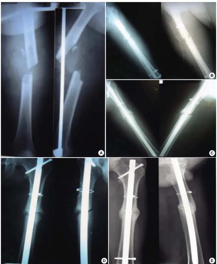 Fig. 3. A 33-old-man with with interlocking IM nailing. 