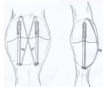 Fig. 1. Modification of  the modified tension band technique shows  using of  the 18 gauge wire crossed anteriorly