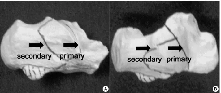 Fig. 1. (A, B) Primary and secondary fracture lines. 