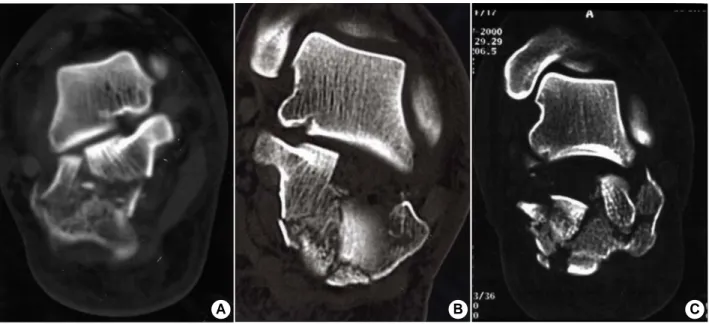 Fig. 1. Preoperative computed tomography (CT) show fracture line and step-off  of  the posterior subtalar joint