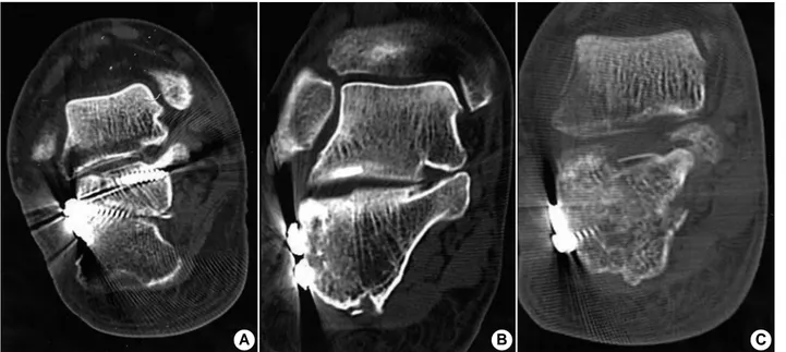 Fig. 2. CT coronal section show postoperative reduction of  the posterior subtalar joint