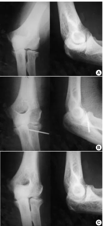 Fig. 2. (A) graph of  57 year-old male patient shows comminuted  radial head fracture