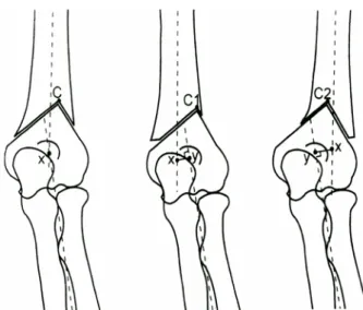 Fig. 1. Schematic drawing of  the preoperative plan: The line AB  is 1 cm above olecranon fossa, and perpendicular to the lateral  supracondylar ridge