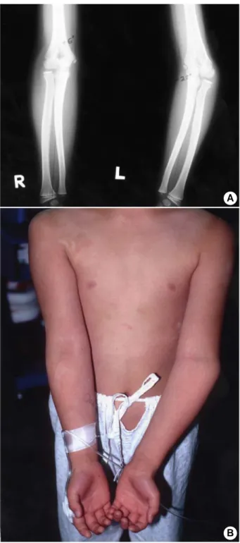 Fig. 3. (A) Preoperative anteroposterior radiograph of a 8-year old  boy demonstrated left sided cubitus varus deformity of  -22° 