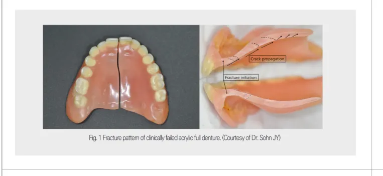 Fig. 1 Fracture pattern of clinically failed acrylic full denture. (Courtesy of Dr. Sohn JY)