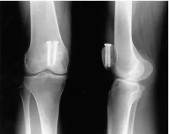 Fig. 2. Anteroposterior and lateral plain radiographs showing inte-  rnal fixation with two screws and a circumferential wiring with 2  mm thick Dall Miles' cable as a primary fixation, and a tension  band wiring as an additional fixation