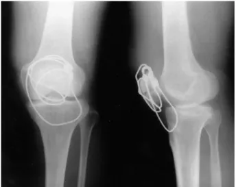 Fig. 3. Anteroposterior and lateral plain radiographs showing in-  ternal fixation with a circumferential wiring with 2 mm thick Dall-  Miles' cable as a primary fixation and a tension band wiring and a  load sharing cable as the additional fixation