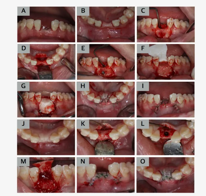 Figure 2.  Guided bone regeneration procedure with FDBA, resorbable membrane and tent screw