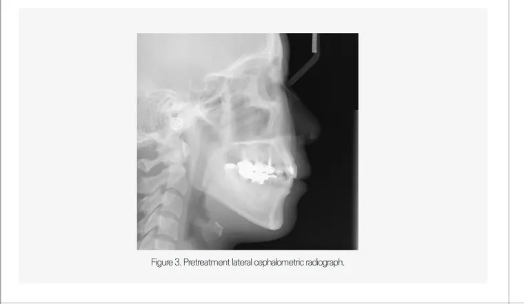 Figure 3. Pretreatment lateral cephalometric radiograph.