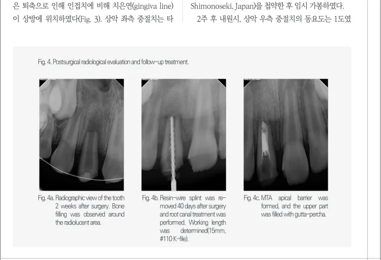 Fig.  4a.  Radiographic view of the tooth 