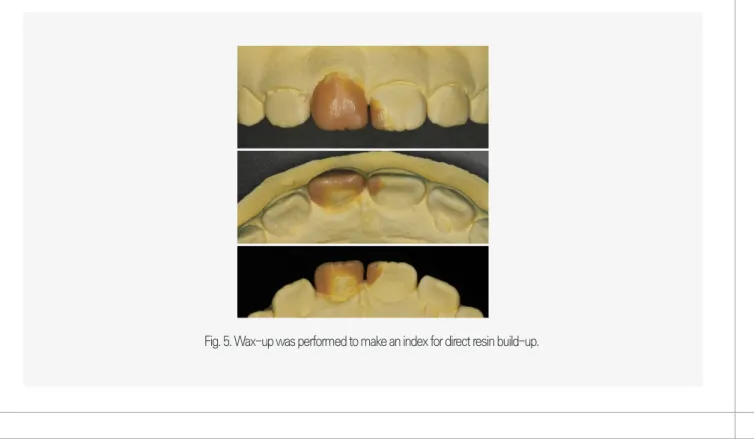 Fig. 5. Wax-up was performed to make an index for direct resin build-up.