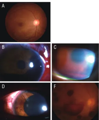 Figure 1.  Preoperative (A) and postoperative photograph (B-F,  case 1). (A) Preoperative fundus photograph without any sign of  lupus retinopathy