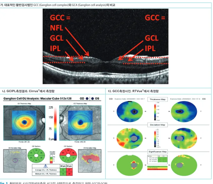 Fig. 1.  황반부위 시신경절세포층을 비교적 선택적으로 측정하기 위한 GCC와 GCIPL