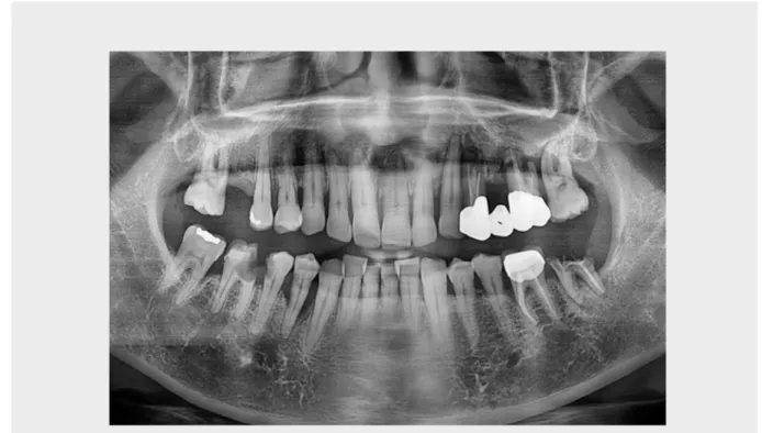Fig. 1. Panoramic radiograph on first visit.