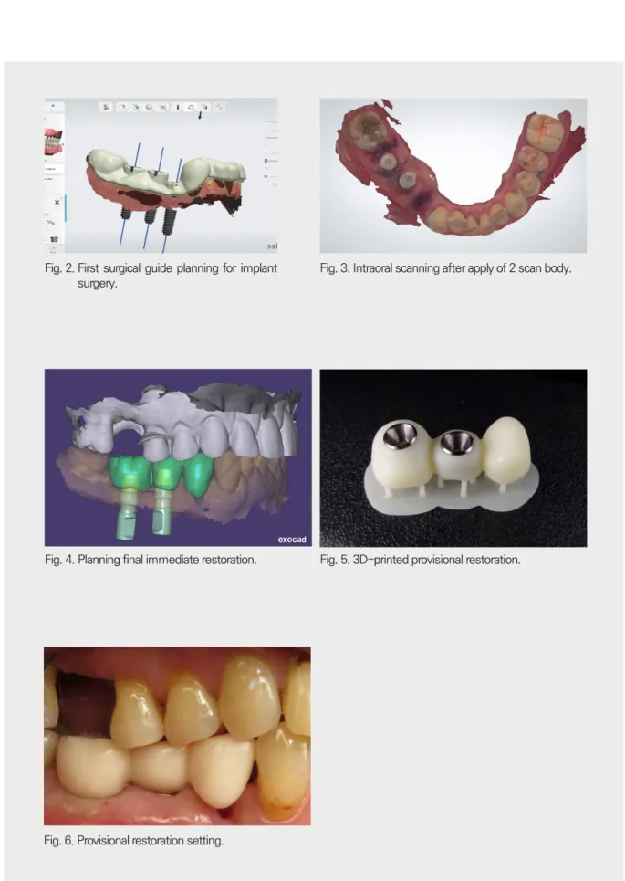 Fig. 2.  First surgical guide planning for implant  surgery. 