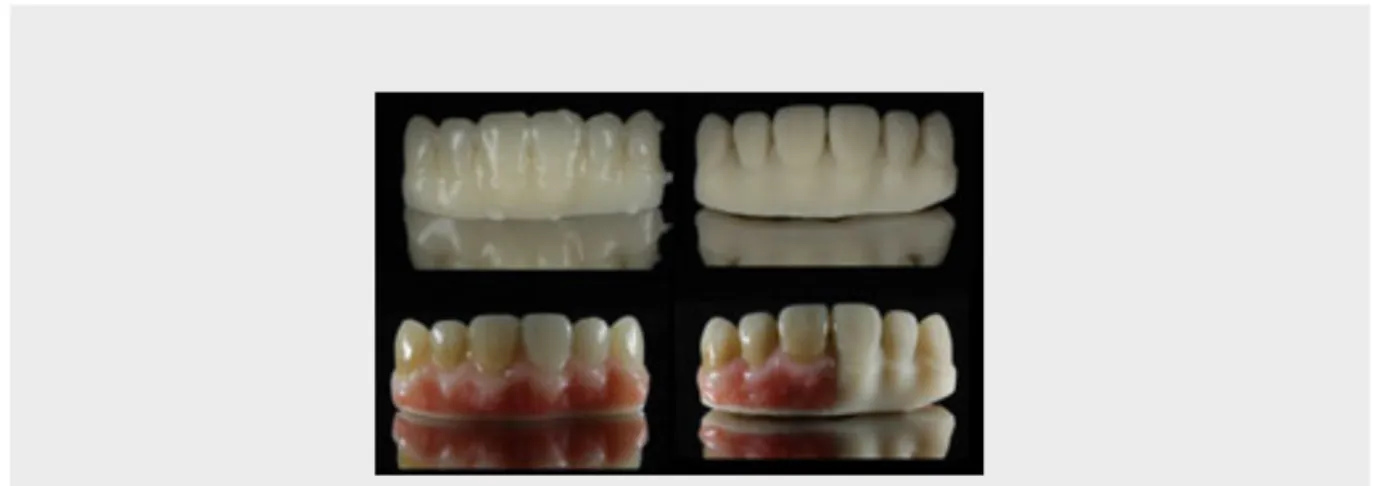 Figure 8. Monolithic digital denture with stain and resin veneering.