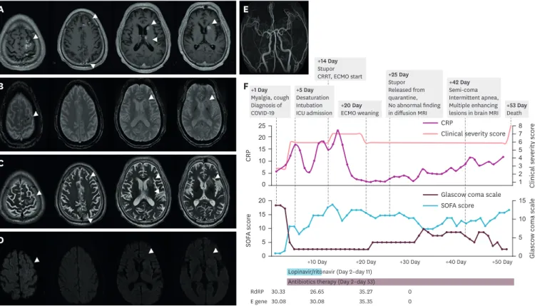 Fig. 1. Radiologic findings and the clinical course of the patient. (A) Axial CE-T1WI show multifocal scattered enhanced lesions in the cortex of the left  frontoparietal lobe, the left caudate nucleus, and the left thalamus