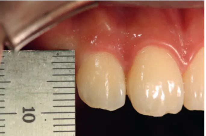 Table 1 shows the descriptive data of the clinical measurements. The specimens were  described on the basis of their crown forms, which ranged from a tapered long form with a  very low CW/CL to a squared short shape with the highest CW/CL