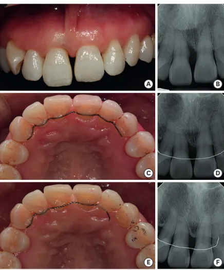 Figure 2. Maxillary fixed retainer. (A) A clinical photograph before periodontal and orthodontic treatment
