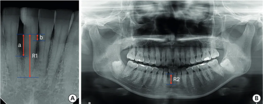Figure 3. Radiographic measurements. (A) The distances between the cemento-enamel junction and the most  coronal level of the alveolar bone were measured at distal (a) and mesial (b) sites on all sets of periapical  radiographs