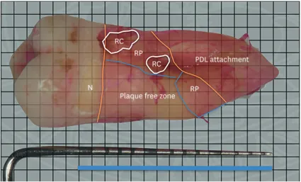 Figure 1. Measurements of RC, RP and total subgingival root area in maxillary first molar