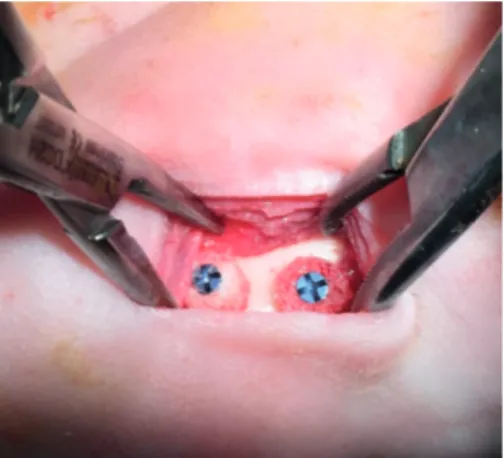Figure 1. The onlay bone graft implantation procedure in which the cylindrical specimens were directly fixed on  the mandible body of the rabbit by a titanium screw.