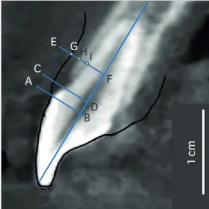 Figure 2. Measurements of periodontal parameters on the superimposed image. A–B: perpendicular line from  the most coronal position of marginal gingiva to the long axis of the tooth; C–D: perpendicular line from the  cementoenamel junction to the long axis