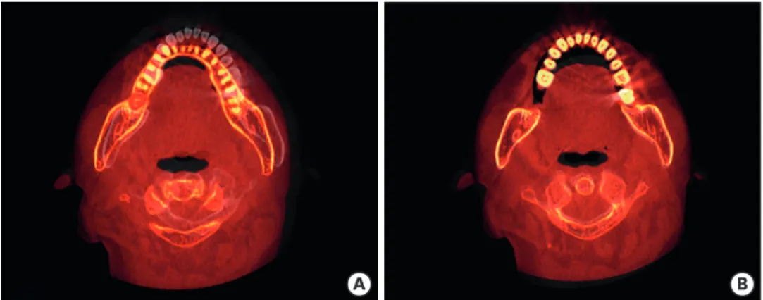 Figure 3. Compensation of the CBCT data obtained on different dates. (A) Two axial views of the CBCT scan at V3  and V4 before superimposition; the primary data (V2) of the gray tone did not match the secondary data (V4) of  the red tone