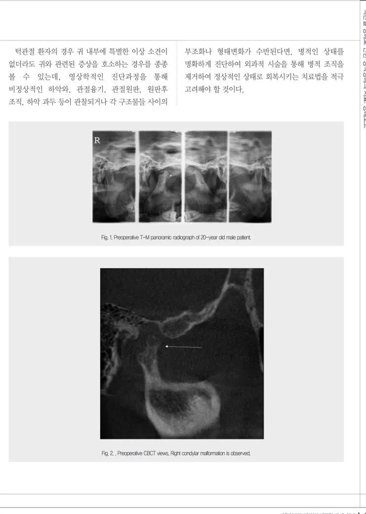 Fig. 2. . Preoperative CBCT views. Right condylar malformation is observed.