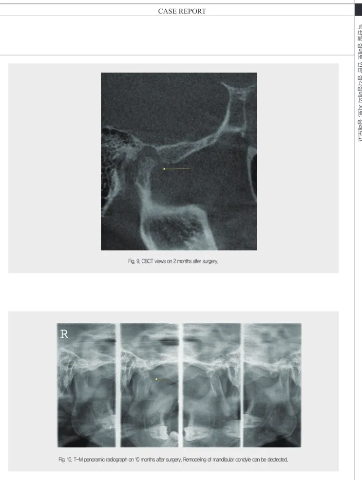 Fig. 9. CBCT views on 2 months after surgery.
