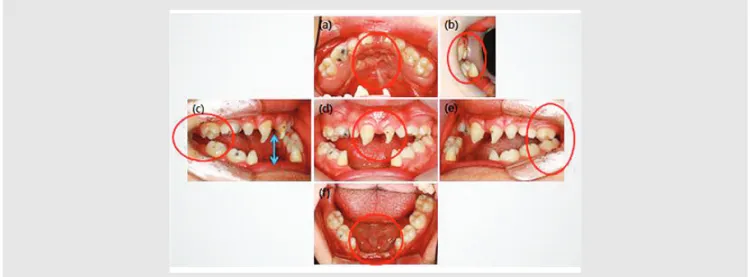 Fig. 1. Initial intra-oral examination (a) Palatal scar (b) Ant. Cross-bite (c) (e) One-point contact occlusion  (d) Conical incisors, severe open bite (f) underdeveloped alveolar bone, oligodontia