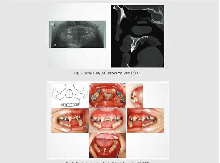 Fig. 3. Surgically Assisted Rapid Palatal Expansion (SARPE)Fig. 2. Initial X-ray (a) Panoramic view (b) CT
