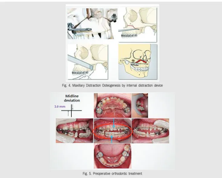 Fig. 5. Preoperative orthodontic treatment