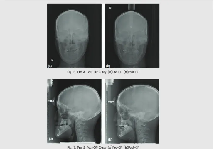 Fig. 7. Pre &amp; Post-OP X-ray (a)Pre-OP (b)Post-OPFig. 6. Pre &amp; Post-OP X-ray (a)Pre-OP (b)Post-OP