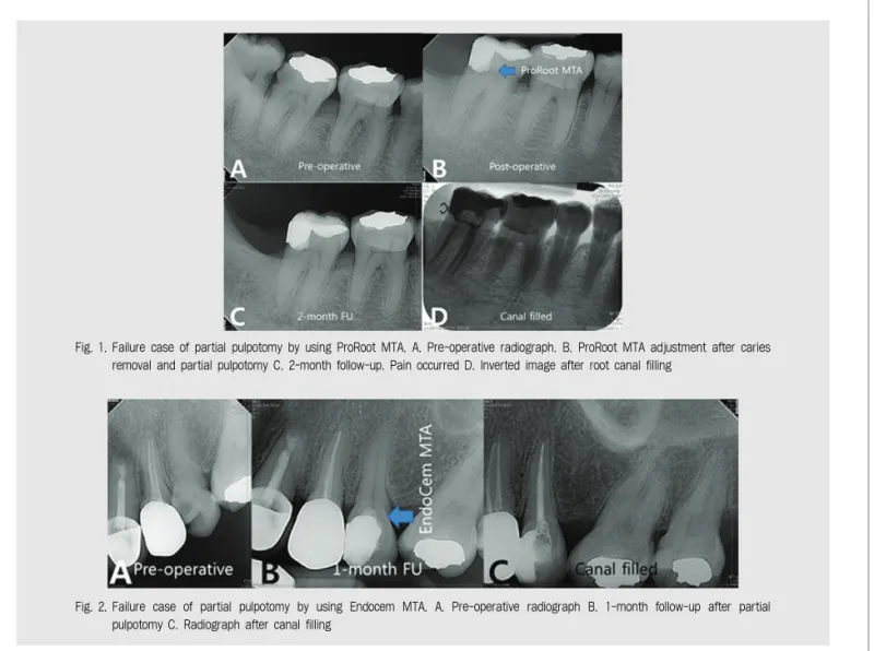 Fig. 1. Failure case of partial pulpotomy by using ProRoot MTA. A. Pre-operative radiograph
