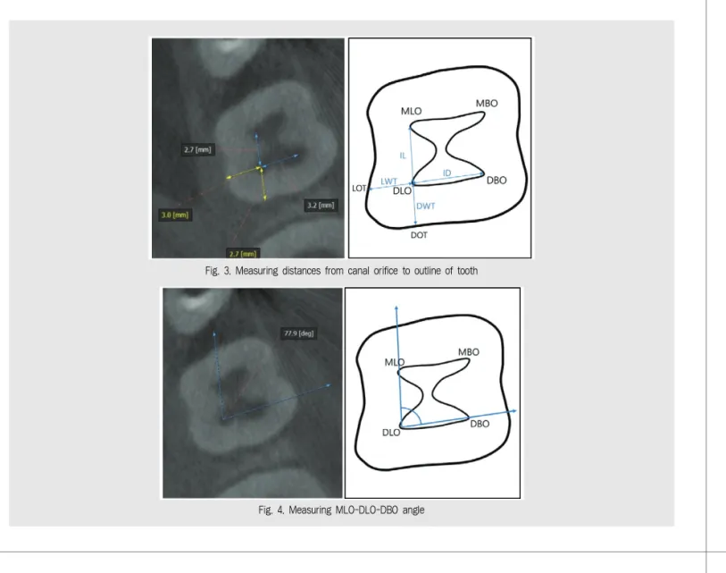 Fig. 3. Measuring distances from canal orifice to outline of tooth