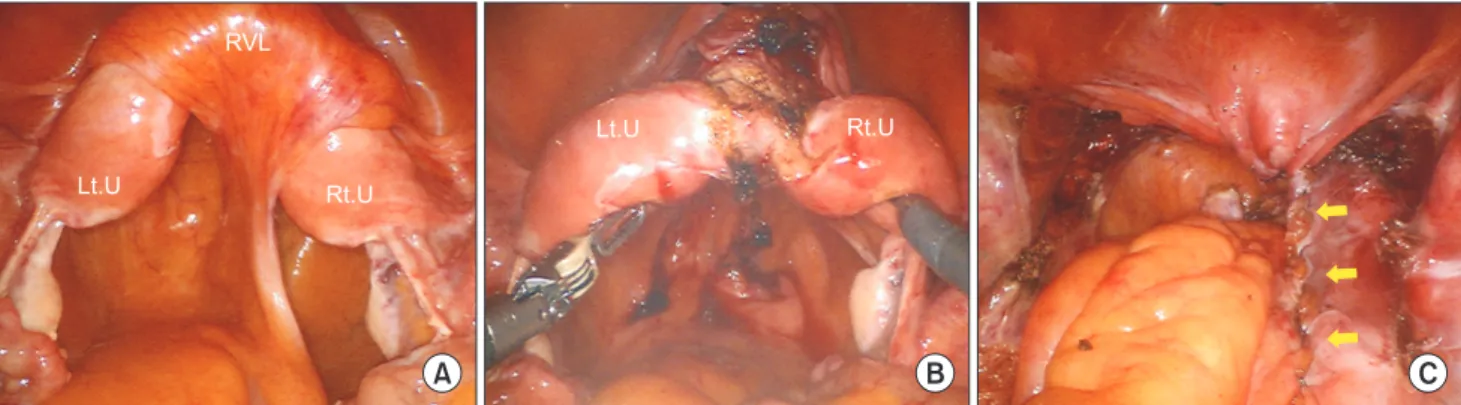 Fig. 1. Laparoscopic view. (A) The rectovesical ligament was crossing the junction between two horns of uterus
