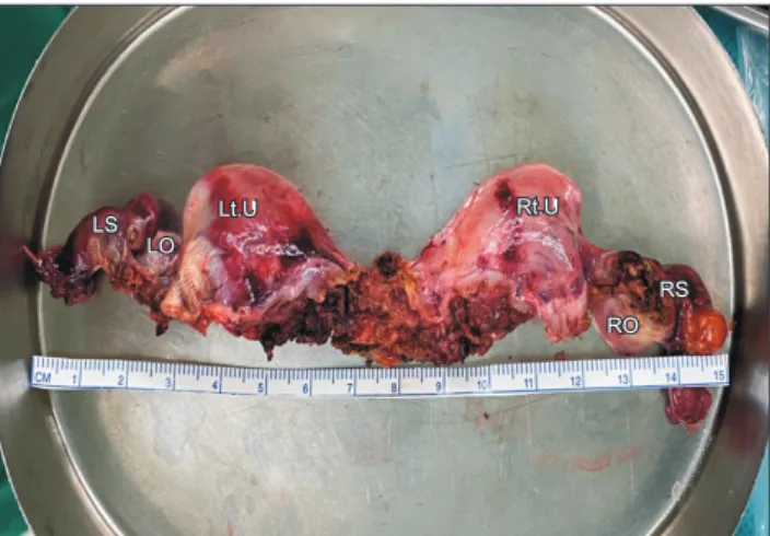 Fig. 2. Postoperative specimen showing bilateral uterine horns with  normal ovaries and fallopian tubes