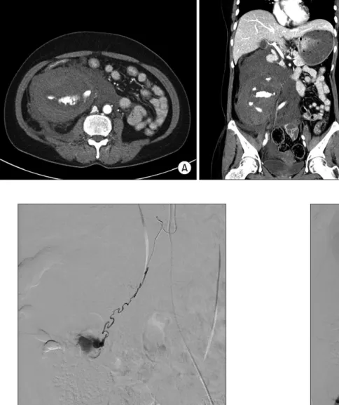 Fig. 1. Contrast-enhanced dynamic  computed tomography: A large  he-matoma with active extravasation  of intravenous contrast in the right  retroperitoneum