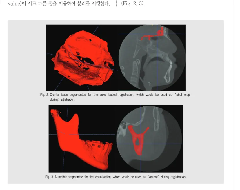 Fig. 3. Mandible segmented for the visualization, which would be used as ‘volume’during registration.