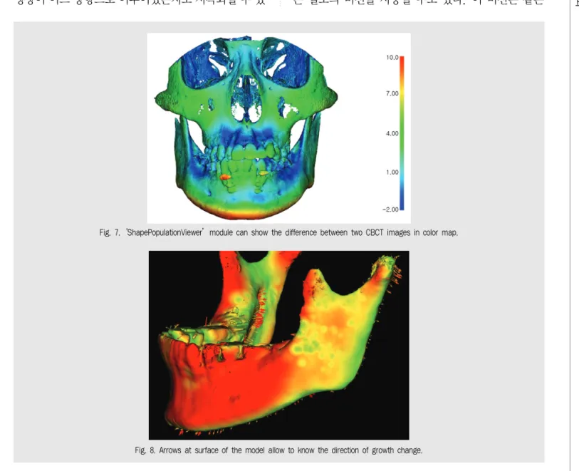 Fig. 7. ‘ShapePopulationViewer’module can show the difference between two CBCT images in color map