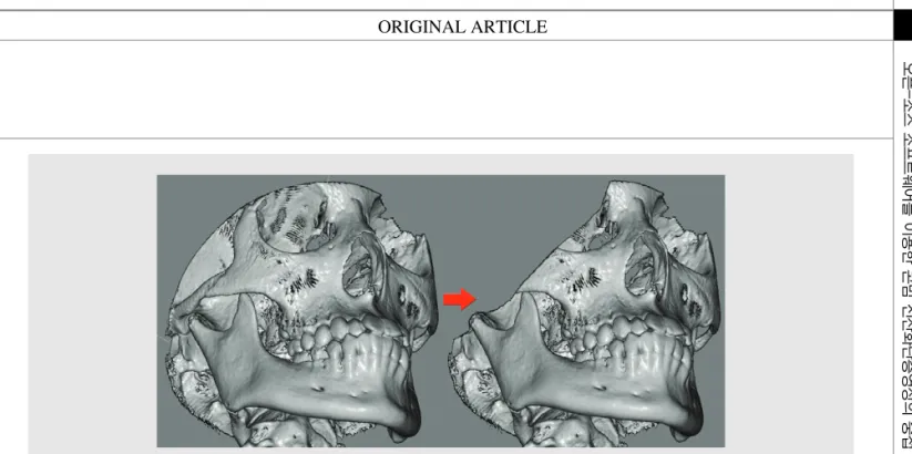 Fig. 10. Invivo  software  provides  three-dimensional  sculpting  tool,  which  can  remove  unnecessary  parts  very efficiently.