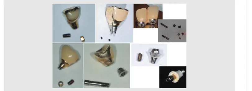 Fig. 1. Clinical failures of abutment and screw due to undefined misfit. 