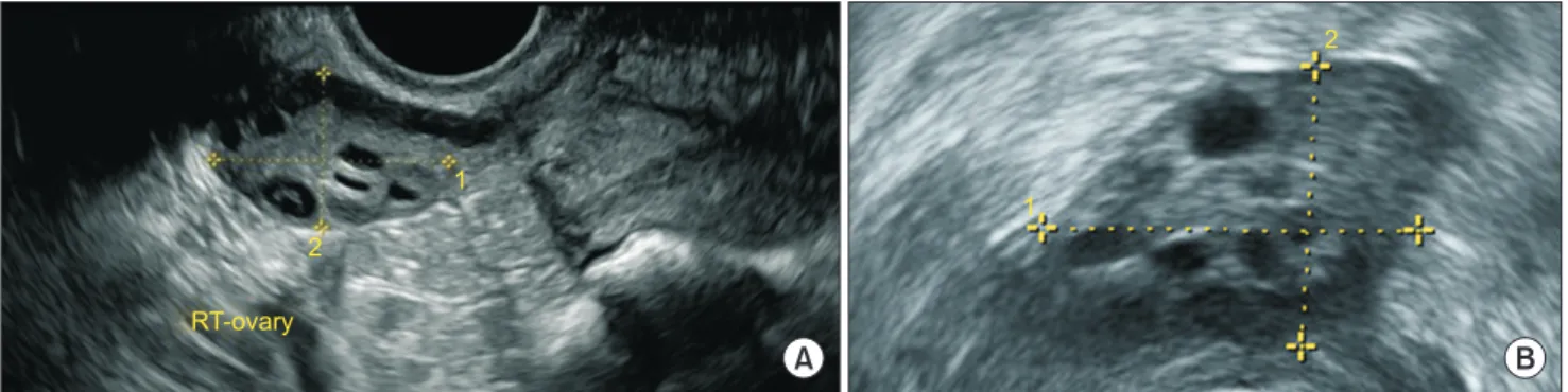 Fig. 1. Ultrasound findings of right (RT) ovary in: (A) Case 1; (B) Case 2. 