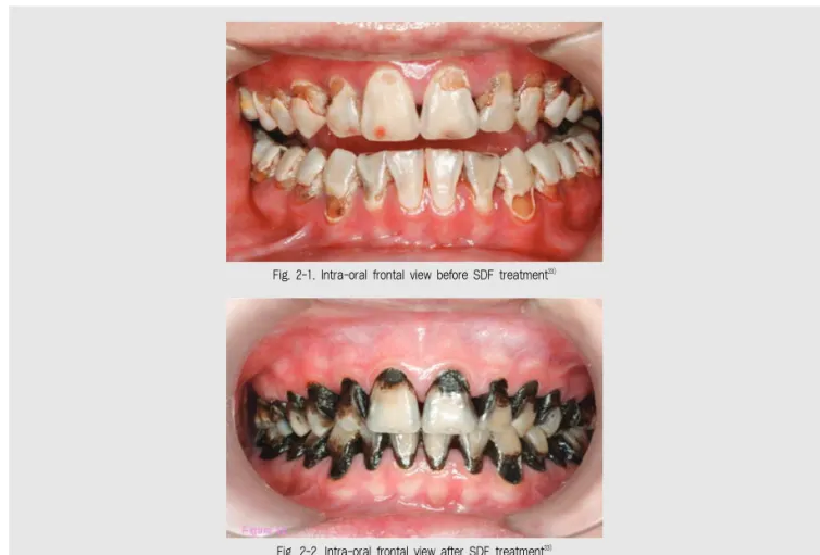 Fig. 2-1. Intra-oral frontal view before SDF treatment 33)