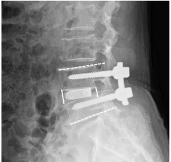 Fig. 2. In postoperative x-ray, the angle formed by the dotted line is the  local lordotic angle and the solid line is intervertebral disc height.